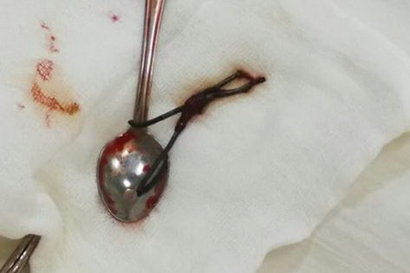 В Махачкале хирурги извлекли из живота пациента чайную ложку и проволоку